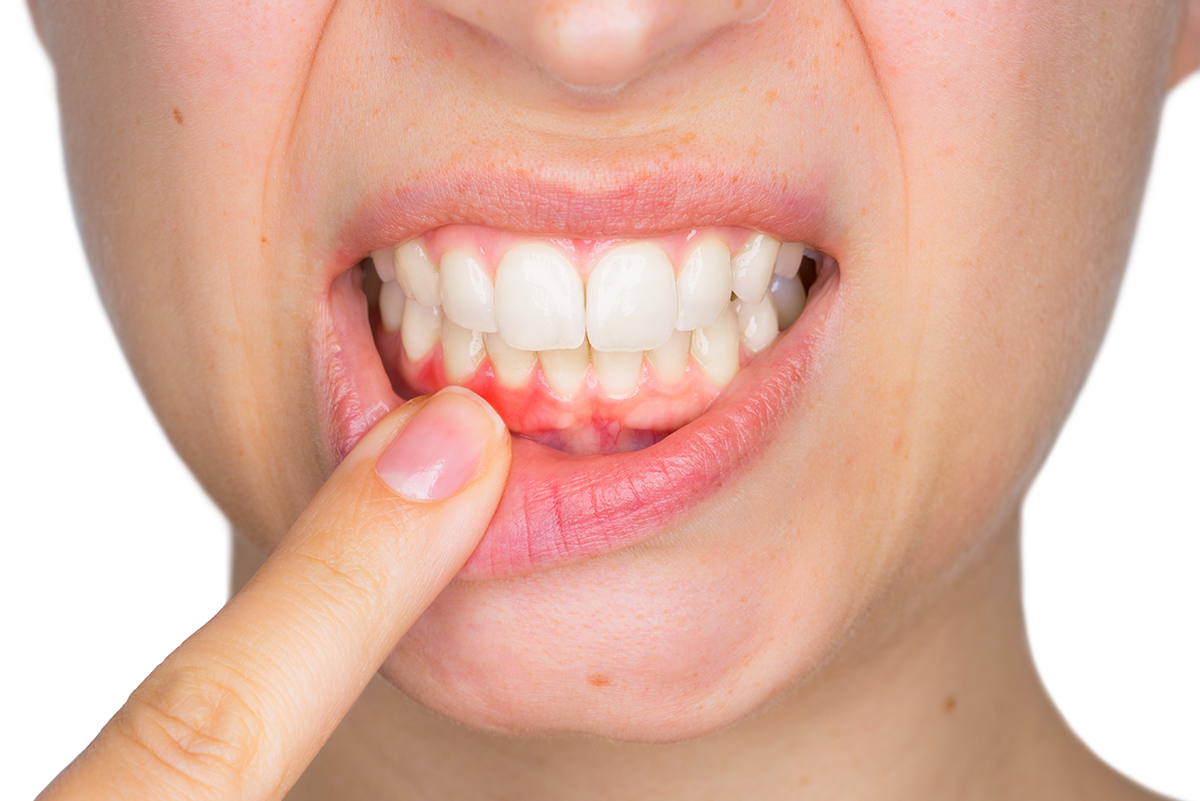 ¿Qué vitamina ayuda a regenerar las encías?