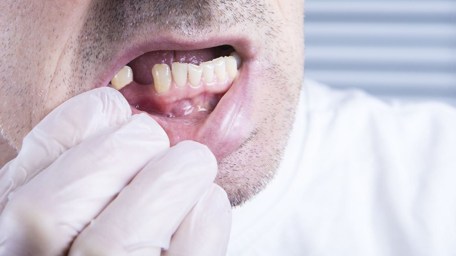 ¿Cómo evitar que se caigan los dientes por la diabetes?