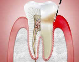 ¿Cómo quitar la periodontitis sin ir al dentista?