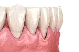 ¿Qué es bueno para endurecer los dientes cuando están flojos?