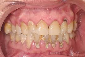¿Cuántos años duran los dientes con periodontitis?