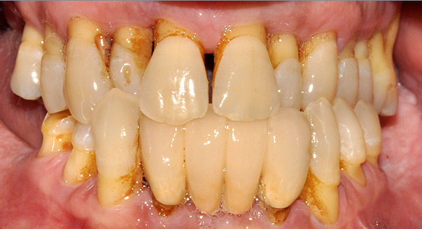 ¿Cómo salvar un diente con periodontitis?