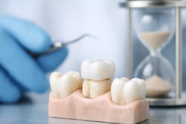 ¿Cuánto dura una corona dental?