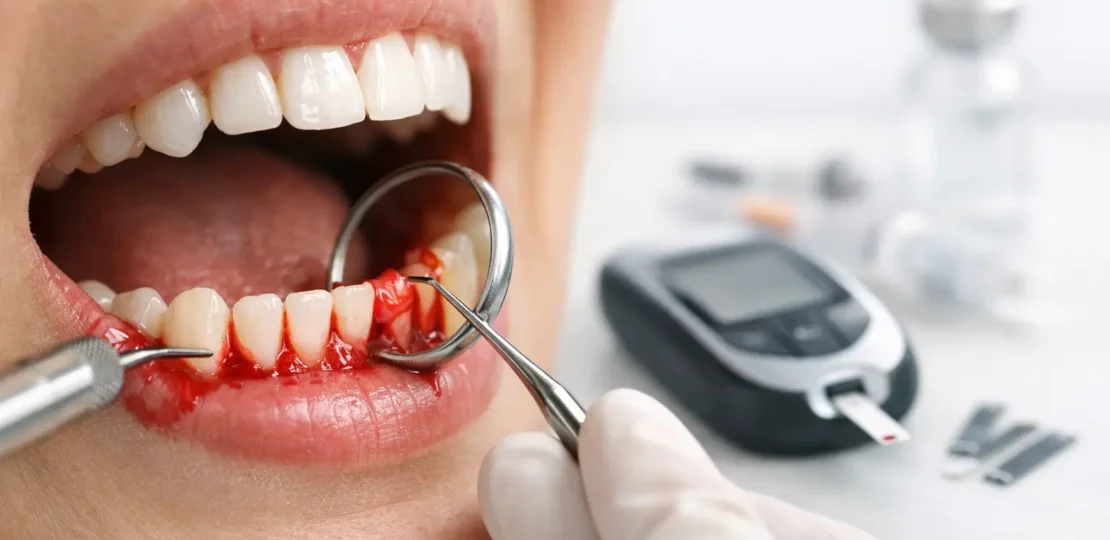 ¿Por qué sangran las encías con diabetes?