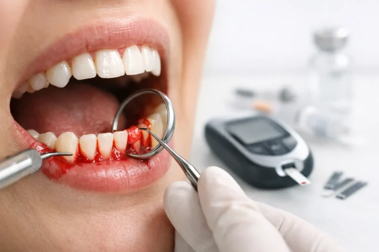¿Por qué sangran las encías con diabetes?