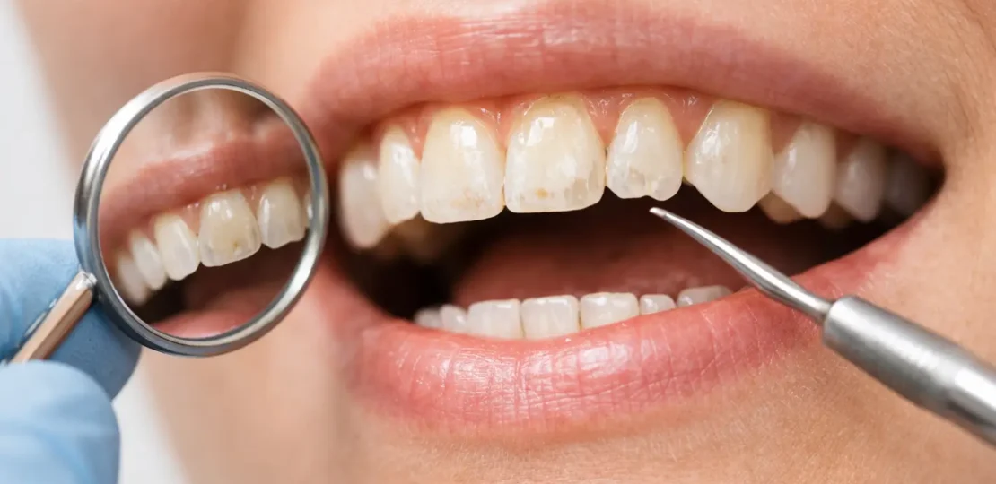 ¿Cuáles son los signos tempranos de erosión dental?