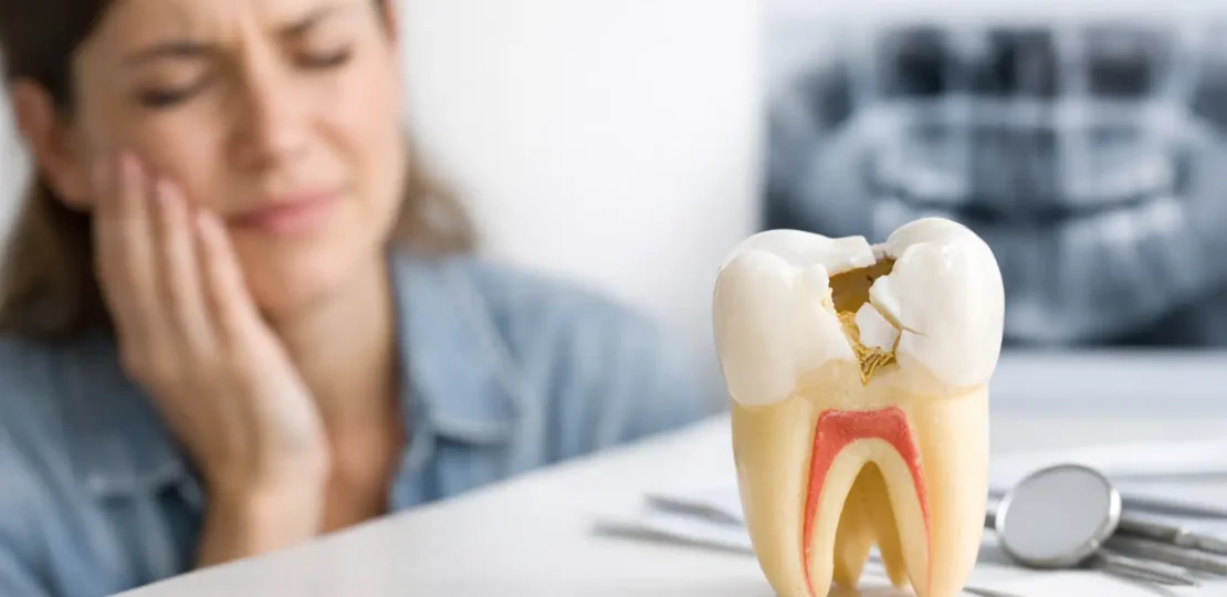 ¿Qué hacer ante una fractura dental?