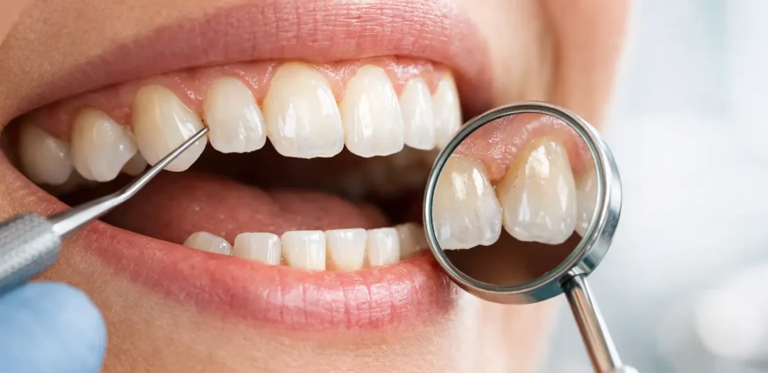 ¿Cómo saber si pierdes esmalte dental?