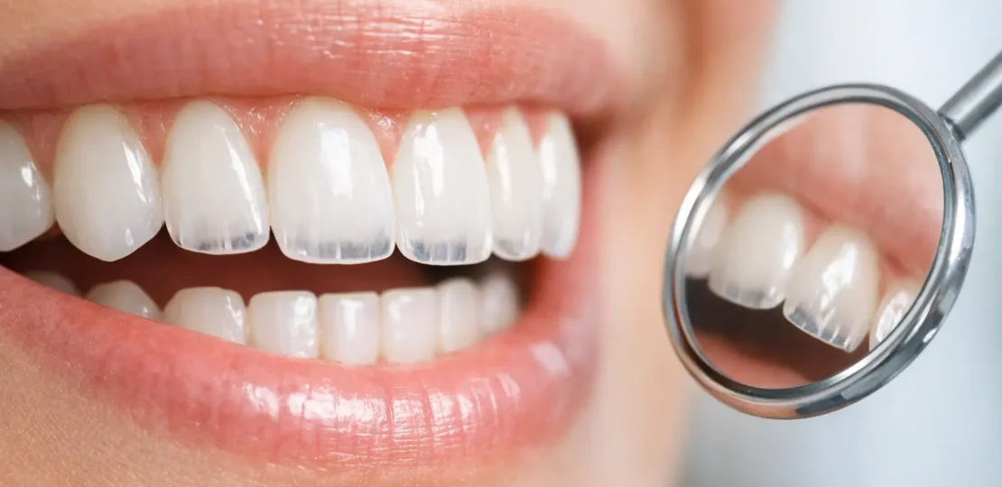 ¿Dientes transparentes en las puntas?