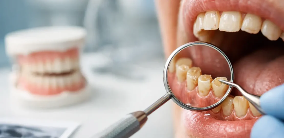 ¿Qué hacer ante casos de desgaste dental severo?