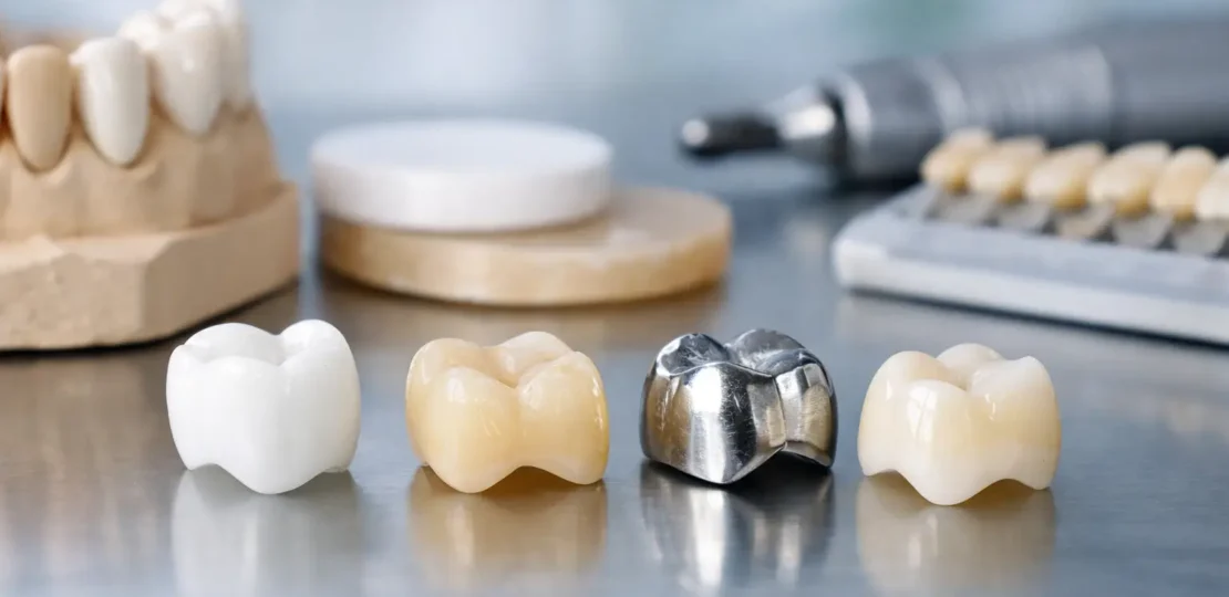 ¿Qué nuevos materiales para coronas dentales elegir?