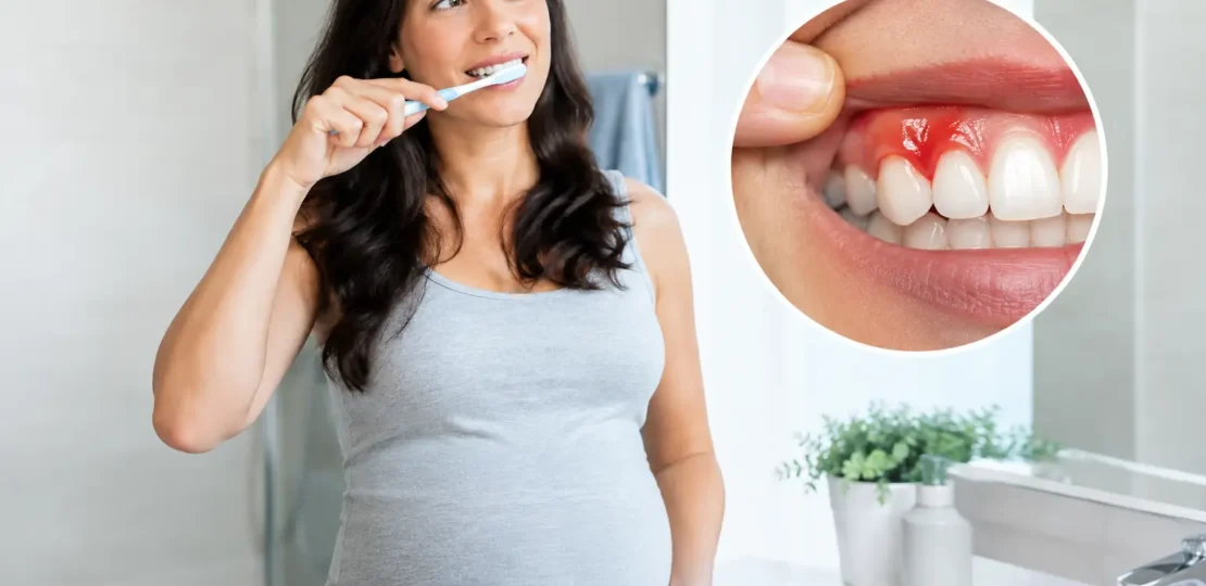 ¿Puede el embarazo causar gingivitis y sangrado?